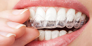 Invisalign  Sirinity Smiles