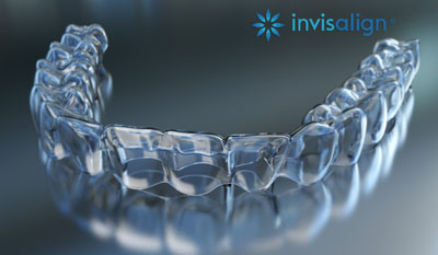 Invisalign  Sirinity Smiles